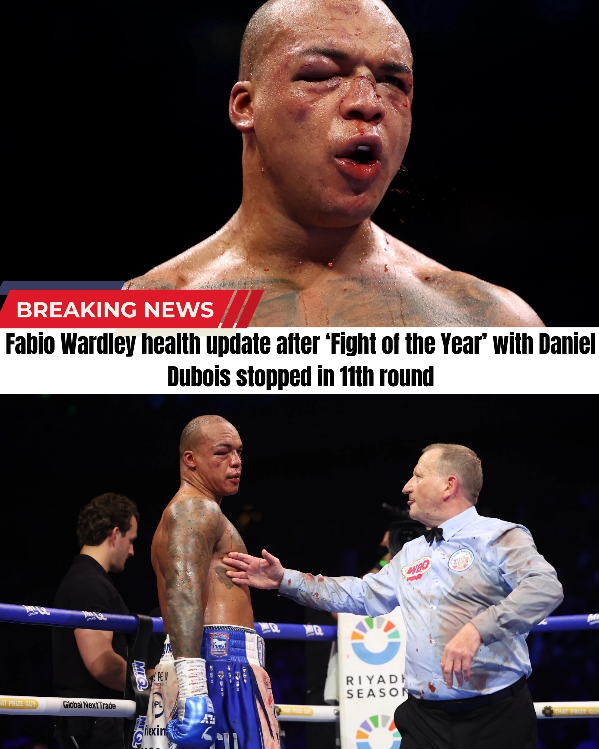 After an 11-round bloodbath against Daniel Dubois that left his face practically unrecognizable, Fabio Wardley DID NOT even go to the hospital!